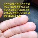 손가락 끝에 엄청난 진동이 들어오고 며칠째 계속 따끔거리는데 손가락 끝이 굉장히 저리고 열감이 심하고 끝마디가 둥글게 부어오름. 이미지