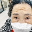 노원역 안호범성형외과에서 상안검 수술 후기
