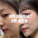 서현 피코토닝 후기: 잡티 고민으로 방문한 서현피부과