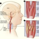 뇌졸중 위험 진단 경동맥 검사 이미지