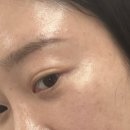 스타벅스 강남대로논현R점 | 강남역 신논현역 피부과 레블라이트 3회차 후기