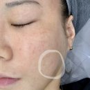 레이저 | 부산 서면 흑자제거 내돈내산 리팟레이저 후기 2