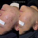 더휴식소륜천안지점 | 천안여드름관리 잘하는 곳 | 아무 일도 없었던 피부 같아요 고객님 후기