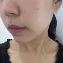 영앤이비인후과의원 | 뷰티앤영 온다리프팅 4만줄 내돈내산 후기 이중턱 효과 아픔 가격 총정리