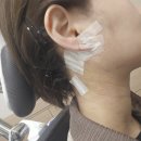 조양아구찜 | 이하선종양 침샘종양 수술후기 2