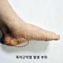 아나파한방병원 | 족저근막염 원인 증상 발바닥통증 치료방법 이렇게 관리하세요