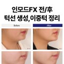 인천 부평 인모드FX 심병관 대표원장님이 알려주는 시술 전 꿀팁