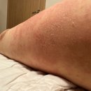 화폐상습진 + 양진 비누와 오일 로션 후기입니다