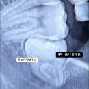 바이럴 아니고 내돈내산 겁쟁이가 보장하는 센텀 첫사랑니 치과 🦷 매복 사랑니 발치 후기