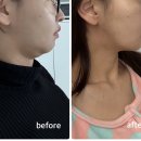 페이스라인성형외과의원 | 강남역 신논현역 성형외과 이중턱살 시술 튠페이스 얼굴 지방분해 루팡주사 한달 튠팡페이스 리얼 후기