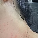 곤골프 | 출산후 늘어난 편평사마귀 제거후 관리 후기(시술4일차~시술8일차)