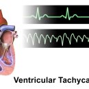빈맥[tachycardia] 이미지