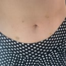 멍마실 | 복부지방분해주사부작용 포함 리얼 후기 1회차 멍·통증·붓기 전후 변화