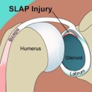 Slap(슬랩)과 bankart(반카르트) 병변 이미지
