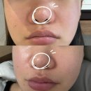 상계한의원 | 상계한의원 얼굴패인흉터 제거 새살침 4회차 후기(코흉터 부작용, 효과)