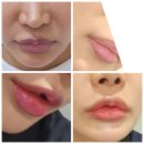전주전 | 전주 입술 필러 전 / 후 달라진!후기