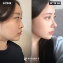 JT빌딩 | 눈코지 전후 셀카/눈재수술, 코성형, 이중턱지방흡입, 근육묶기까지 후기 궁금하면 클릭해!!