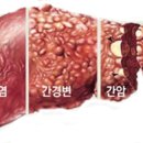 간경변증[liver cirrhosis, LC]이란? 이미지