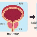 소변 잔뇨감 해결 근본 원인을 알고 바르게 시작해요 이미지