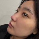 하이코코 | 콧대필러 대신 슈퍼하이코 레이디코후기 | 재시술, 전후사진