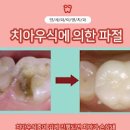 치아파절 원인 및 치료, 보험 (앞니 레진 어금니 크라운 깨짐) 이미지