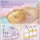 복수(Ascites)란 무엇인가요? – 암 환자의 복부에 차는 물 이미지