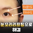 제니성형외과의원 | 눈꼬리리프팅 으로 눈꺼풀처짐,눈꼬리처짐 해결가능😉ㅣ리터닝성형외과