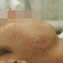 성인 여드름 한의원 후기 깊게 패인 흉터 자국 완벽하게 재생시켰어요!