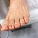 문제성 손, 발 오감네일 이미지