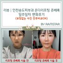 핸드피스닥터 | 인천송도피부과 잘하는곳 온다리프팅 쥬베룩 일주일차 변화후기