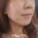 강남-200 | 강남역 피부과 쳐진 턱살 울쎄라 200샷 시술 후기