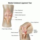 내측 곁인대 재활 운동 프로그램 이미지
