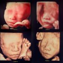 쌍둥이 임신 24주 차 | 임당 검사 한 번에 통과, 둥이 둘 다 입체 초음파 성공 후기, 엄마랑 같이...