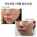엑셀 | 색소치료 8개월 경과비교 엑셀브이후기