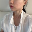 권장덕케이성형외과의원 | 얼굴 지방 흡입 내돈내산 3개월 후기(강남에이탑성형외과)