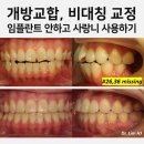 샤인치과교정과 치과병원 | 임플란트 안하고 사랑니 당겨오기, 개방교합 비대칭 비수술 교정치료 후기