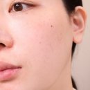 분당 서현역 미술관 피부과 추천 기미 잡티 색소레이저 피코토닝 + 비타민관리 리얼후기