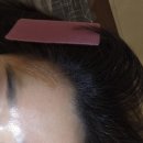 서울에이스병원 | 정발산 왁싱 에이스 왁싱에서 이마 왁싱 받고 깐달걀 된 후기