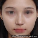 민성형외과의원 | [코성형] 미간이 낮고 ,코끝이 처진 코 자연스럽게 개선하기