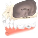 돛골 | 상악동 거상술 후기 통증 부작용 피하고 싶으면 필독