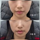 얌얌이 - 6587 | 구로피부과 볼뉴머600샷 효과/통증/시술과정 후기