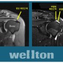 어깨 회전근개파열에 대해 알아봅시다. 이미지