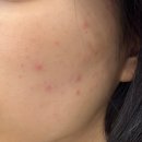 홍당무학원 | 일생일대 기회 다 날려버린 스킨보톡스+히알루로산 부작용 및 대처 후기