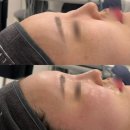 태인메디칼 | 인천 부평 피부관리 리우에스테틱 슈퍼젝션 프리미엄 예신 관리 내 돈 내산 후기