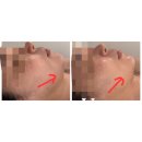 두정상가1길27 | 두정동리프팅 에버림에스테틱 싸이블로 후기 통증없이 1회 효과