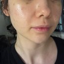 발산피부과 리바이브 스킨부스터 일주일 솔직후기 (통증, 가격, 비교)