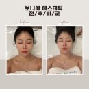 대구 윤곽관리 추천 보니예 에스테틱 월성동 피부관리 브이라인 후기