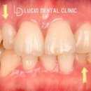세기치과기공소 | 선정릉역 치과 "누렇고 삐뚤빼뚤한 치아에서 연예인 치아로, 이제 맘 편히 웃어보세요." 착색 및 크기...
