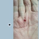 뇌전증( 간질, 전간) 이미지