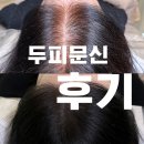 자연엔 | 강남 두피문신 후기 정수리 자연스럽게 커버